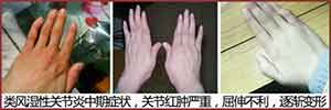 成都风湿医院类风湿性关节炎中期患病关节典型症状