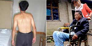 成都风湿医院强直治疗不当,耽误治疗时机,易造成患者脊柱畸形甚至残疾